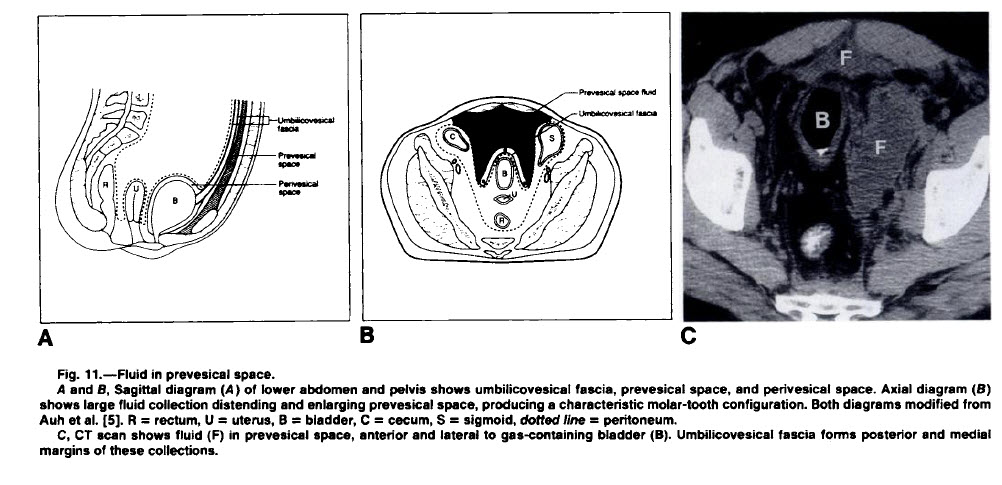 molar tooth sign